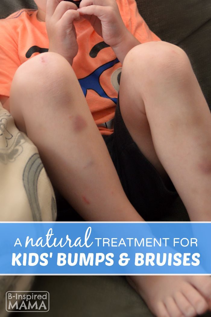 Our New Go-To Homeopathic - Natural - Treatment for Kids Bumps and Bruises at B-Inspired Mama